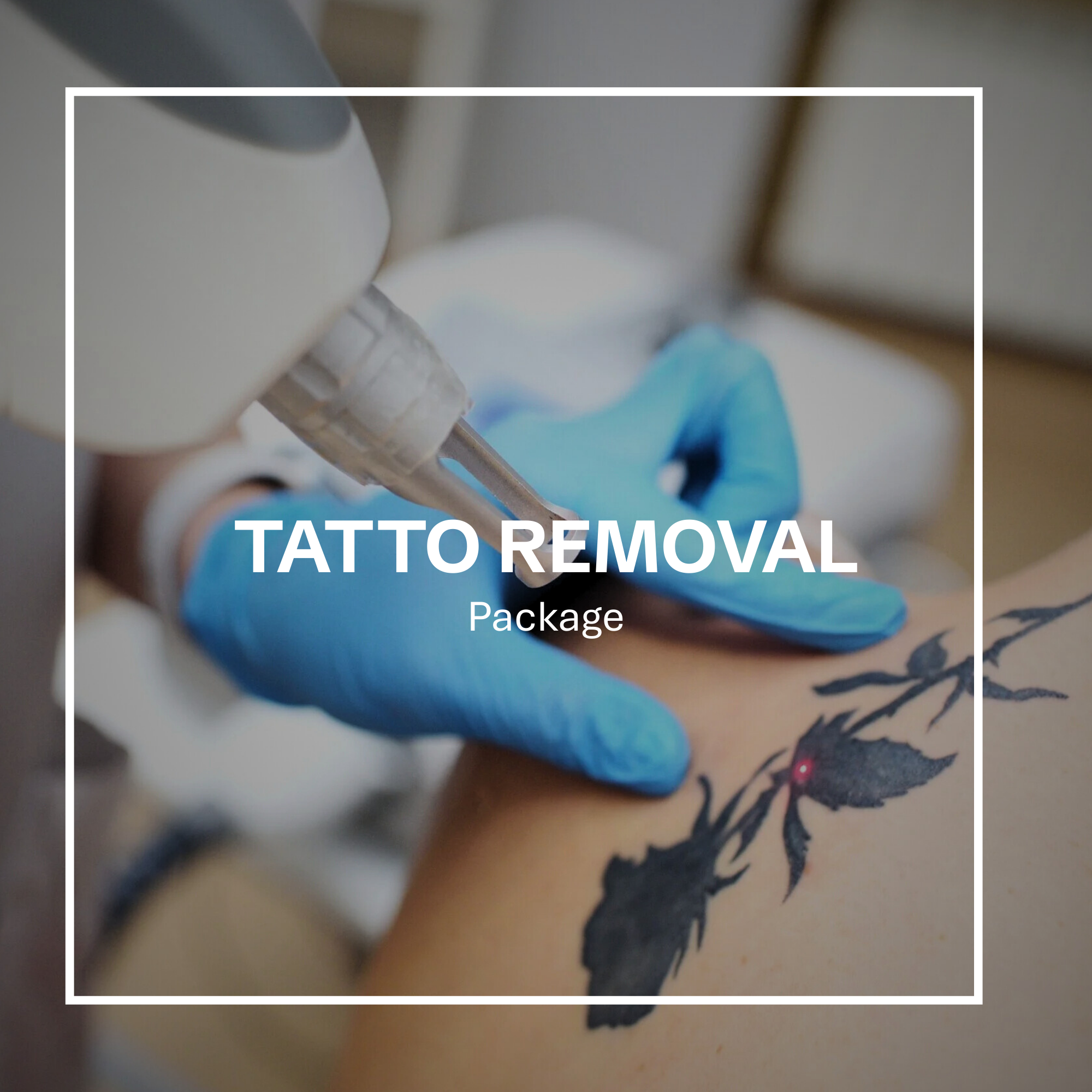 Laser Tatoo Removal Package