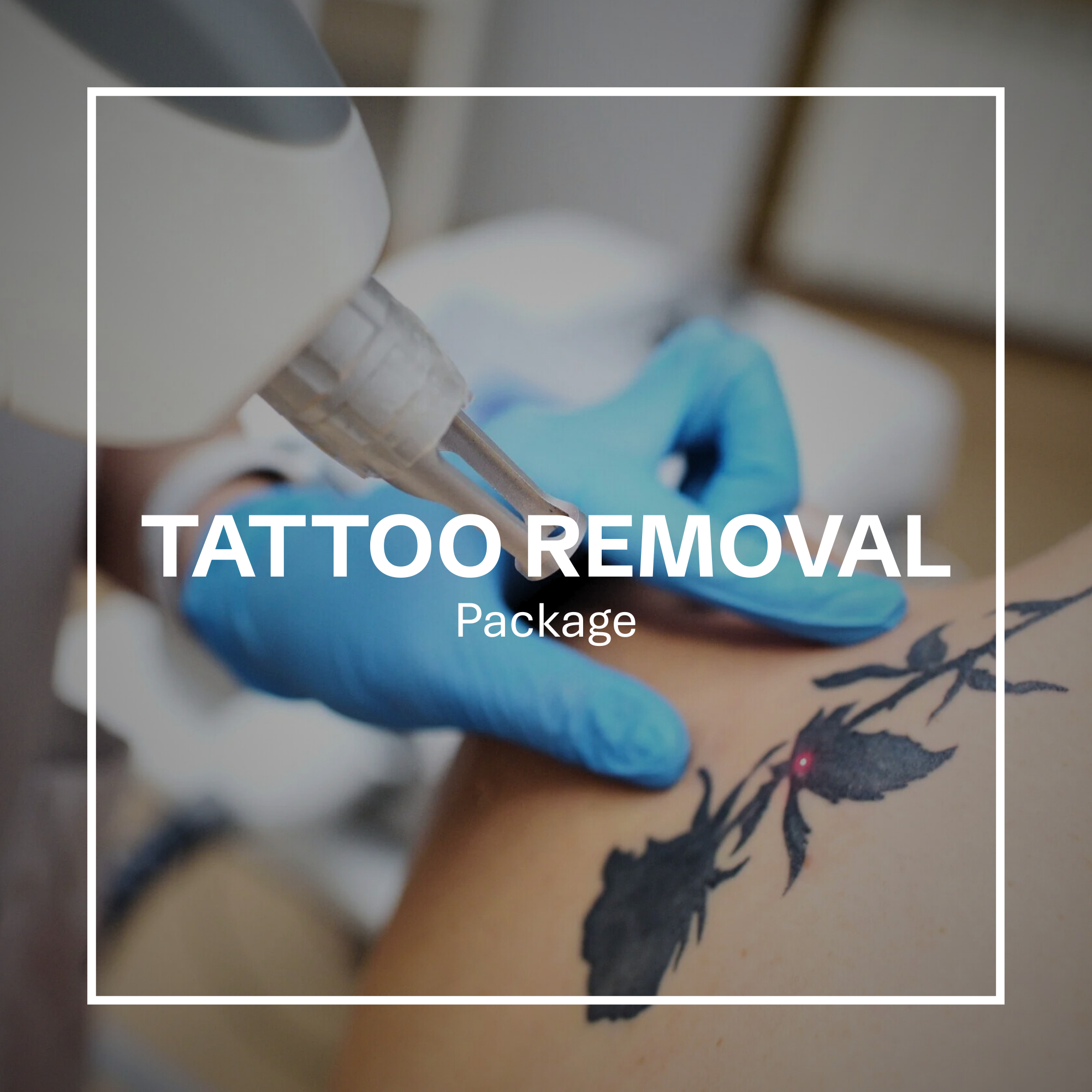 Laser Tatoo Removal Package